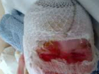 Недалеко от Шахт в поселке Казачьи Лагери маленькая девочка обварила себе лицо кипятком