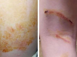 12-летний ребенок стал жертвой нападения собак, возвращаясь из школы в Шахтах