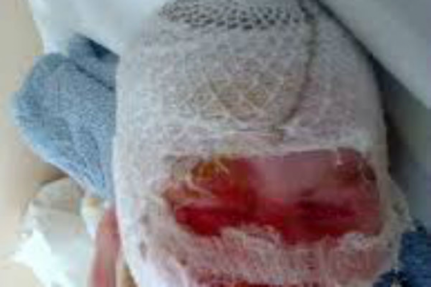 Недалеко от Шахт в поселке Казачьи Лагери маленькая девочка обварила себе лицо кипятком