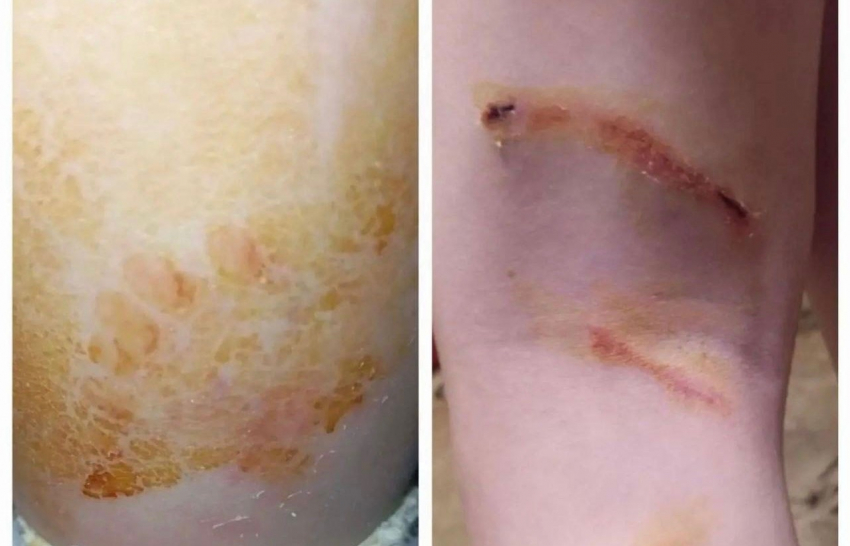 12-летний ребенок стал жертвой нападения собак, возвращаясь из школы в Шахтах